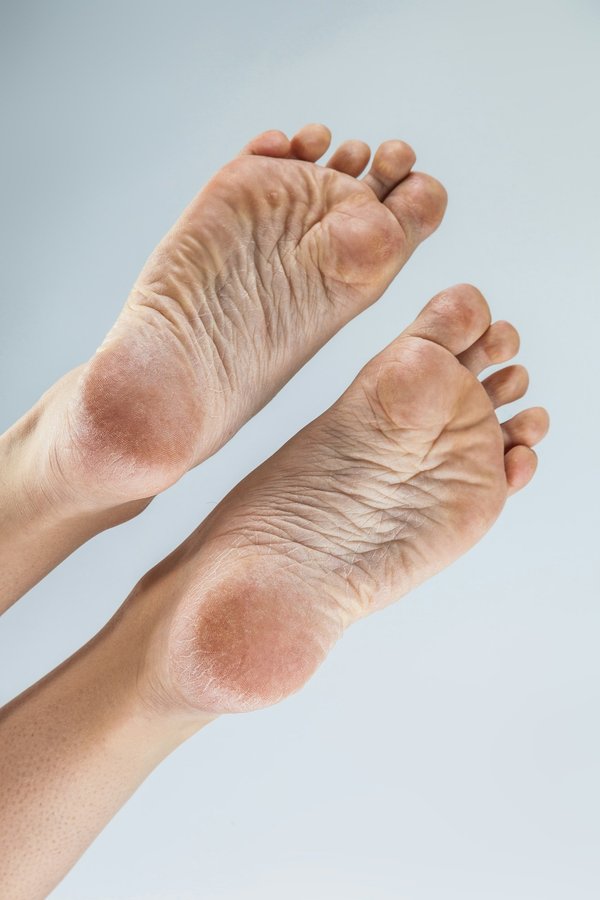 Soulagez la douleur de l'épine calcanéenne avec nos semelles